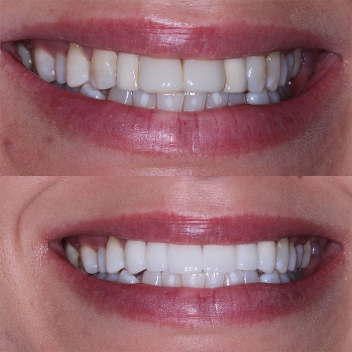 Before and after smile makeover result