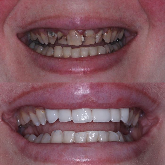 Before and after cosmetic dentistry result