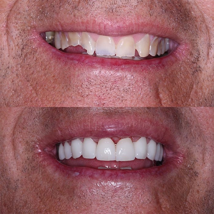 Before and after smile transformation at Shell Cove Dental